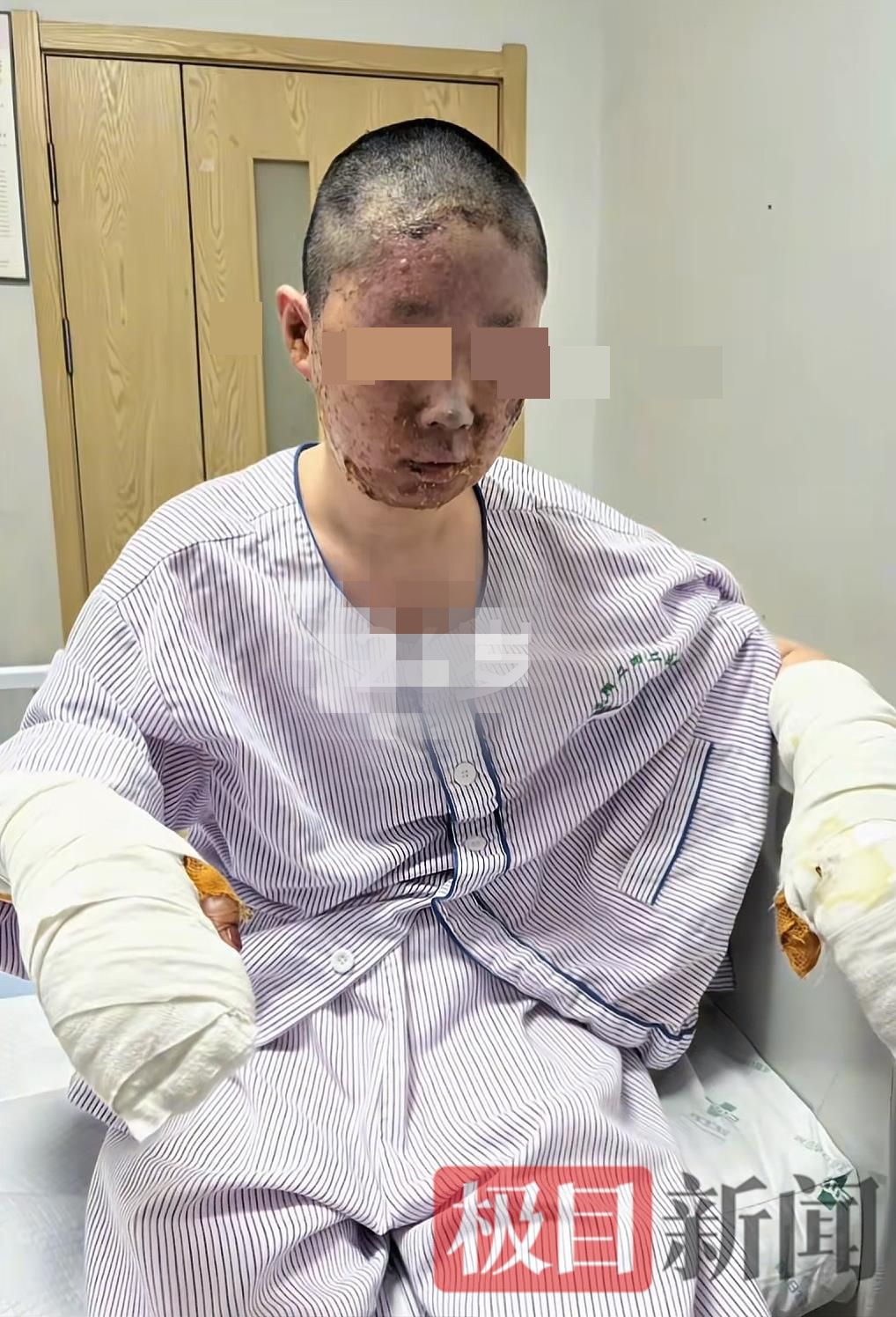 27岁美妆博主自述被家中液化气泄漏烧伤后毁容，做自媒体补贴医疗费