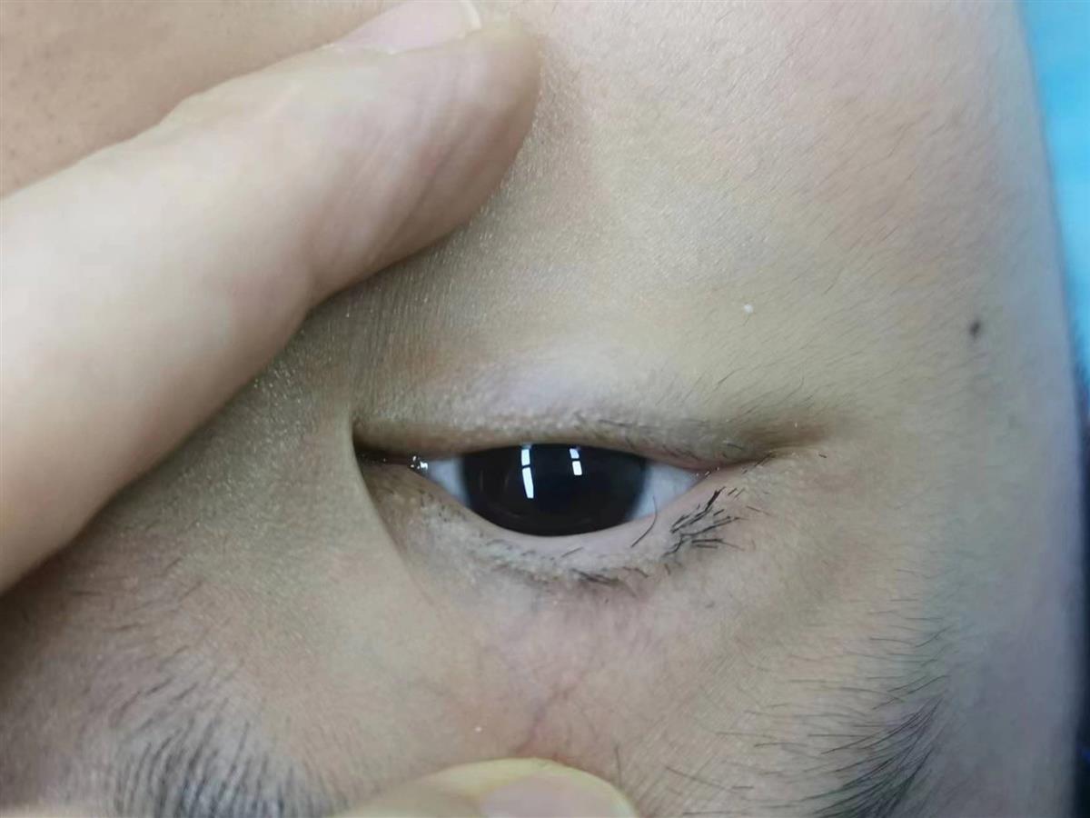 睫毛倒生孩子常捽眼 兒科醫生指嚴重會永久影響視力