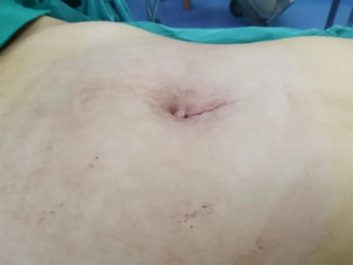 手术后，女孩腹部明显变小（图源：玉林晚报）.jpg
