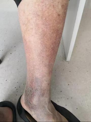 天冷引发老年皮肤瘙痒困扰，医生实用建议助您缓解痛苦