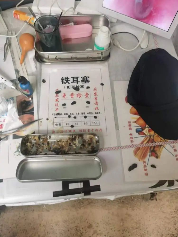 掏个耳朵花了近6千元！真不敢相信我的耳朵……