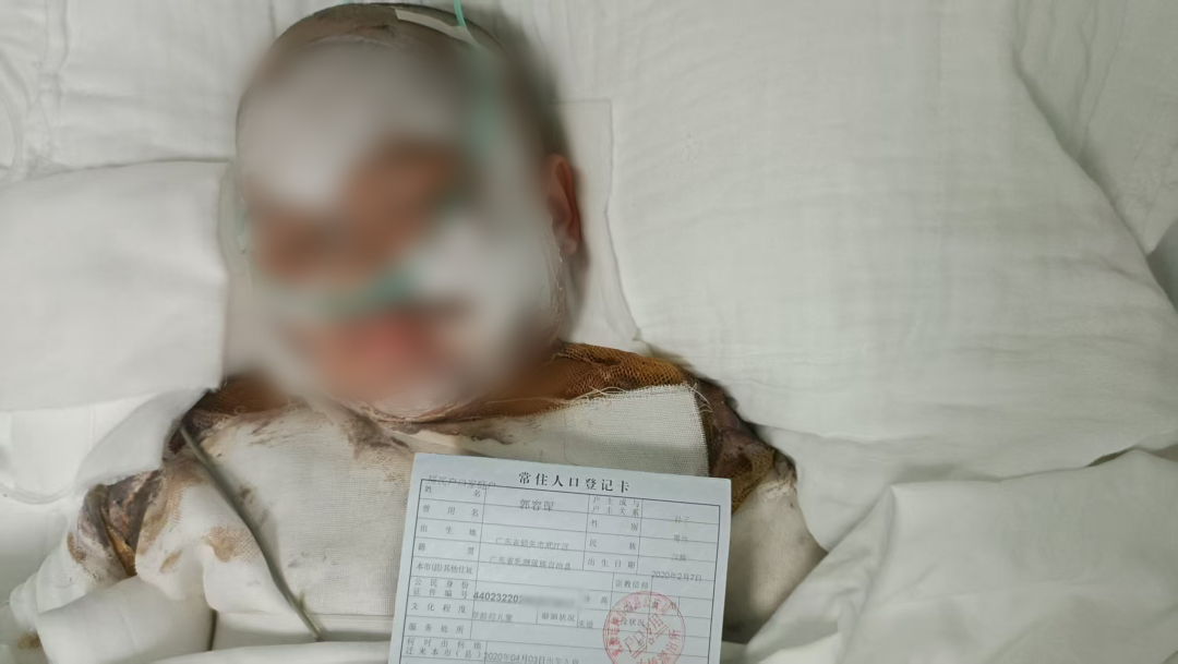 跌入烧开豆浆水桶，广东5岁男童特重度烧伤！医疗费用无法估算，社区为负债家庭倡议募捐
