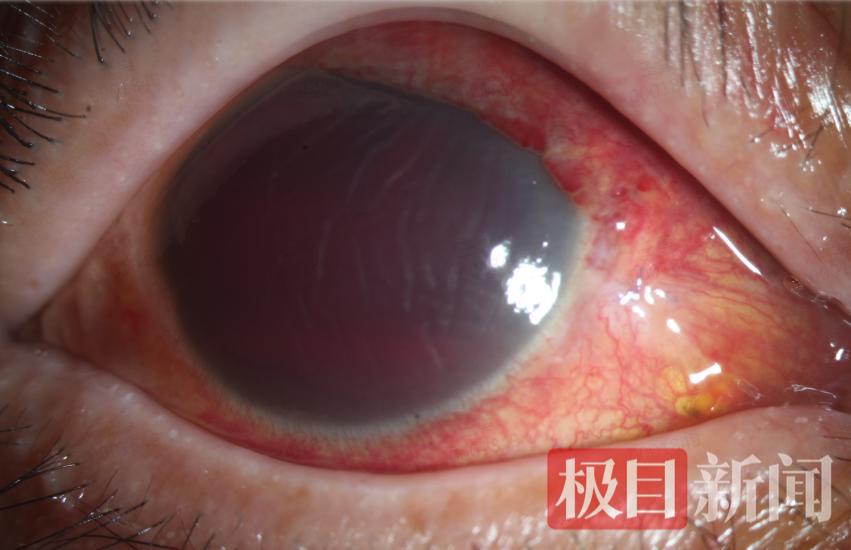 患者右眼摔伤.png