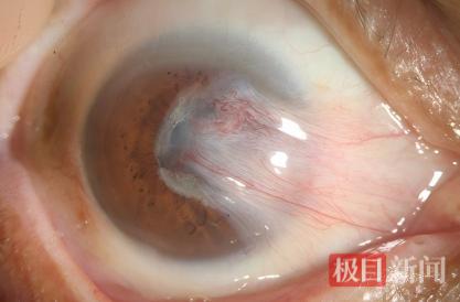 遮挡患者视线的翼状胬肉.png