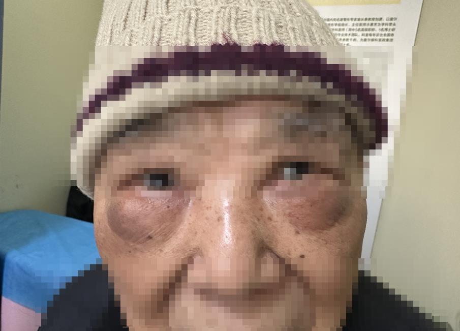 老人的眼袋十分“明显”.png