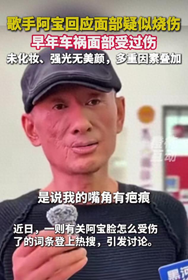 57岁歌手阿宝脸部疑似被烧伤，本人回应：嘴周疤痕是一次意外车祸所致，我快60岁了，早已不注重形象管理了