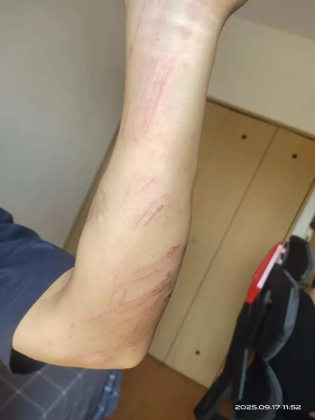 杨先生手臂被擦伤（图源：受访者）