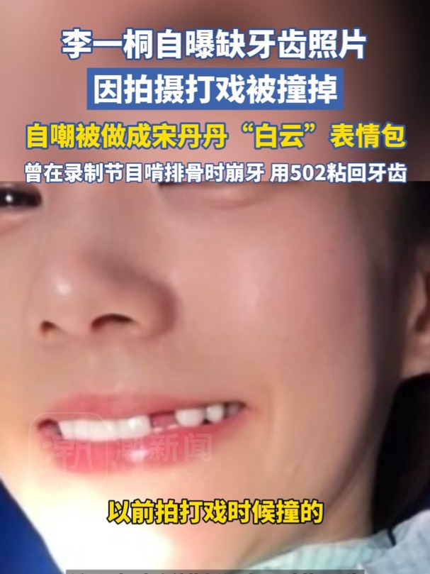 李一桐自曝缺牙照片：拍摄打戏被撞掉！自嘲做成宋丹丹 “白云” 表情包，此前用502粘牙