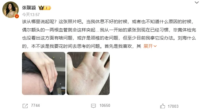 歌手张靓颖自曝营养不良