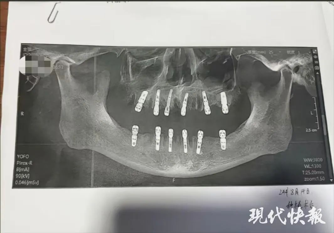 浙江男子一次性拔牙23颗种12颗，13天后去世！卫健部门已介入