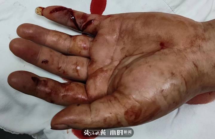 露营时被不知名小蛇咬了一口,台州罗先生的手肿成"馒头" | 极目新闻