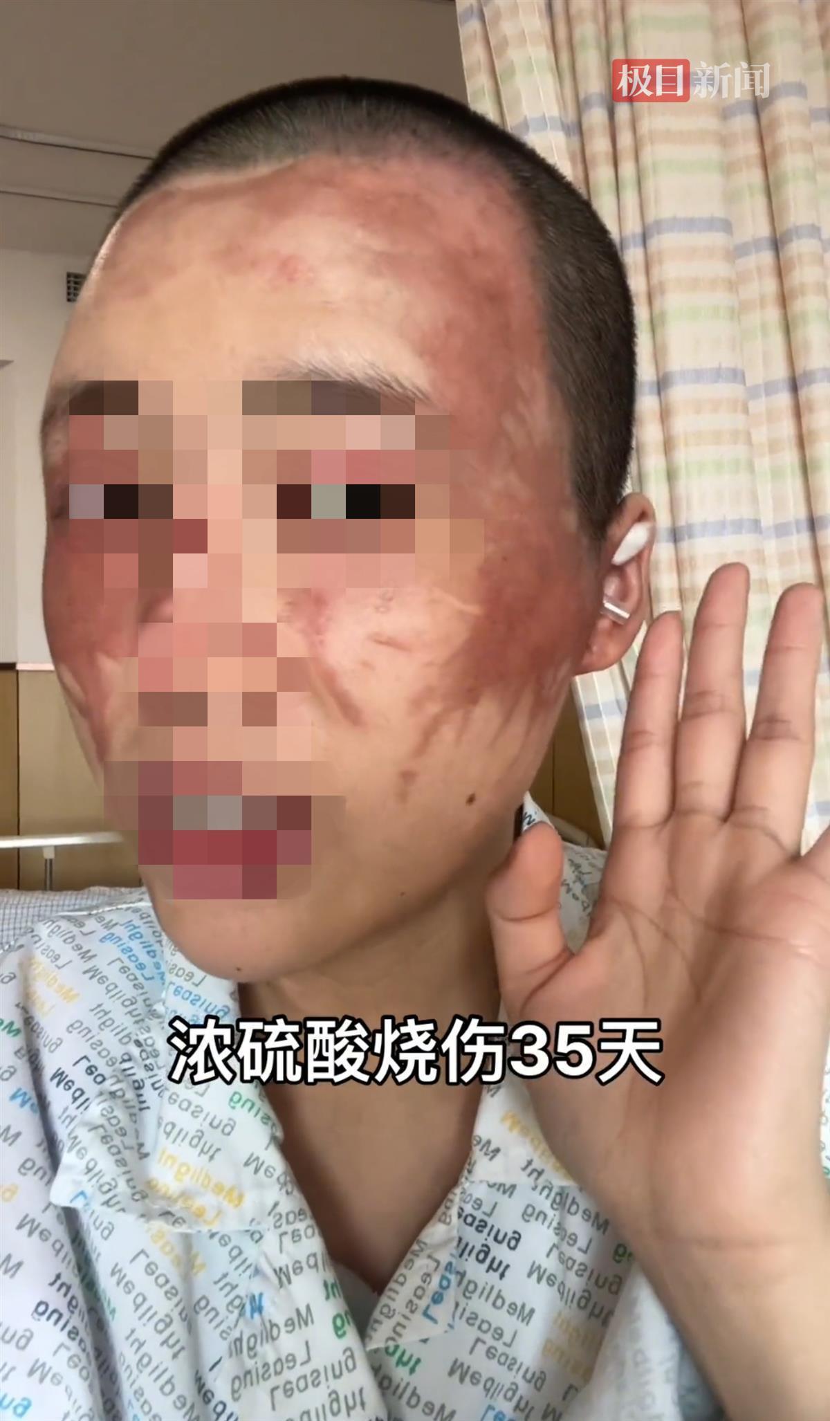 女子遭家暴被丈夫泼硫酸,烧伤科专家:伤情鉴定或为重度烧伤