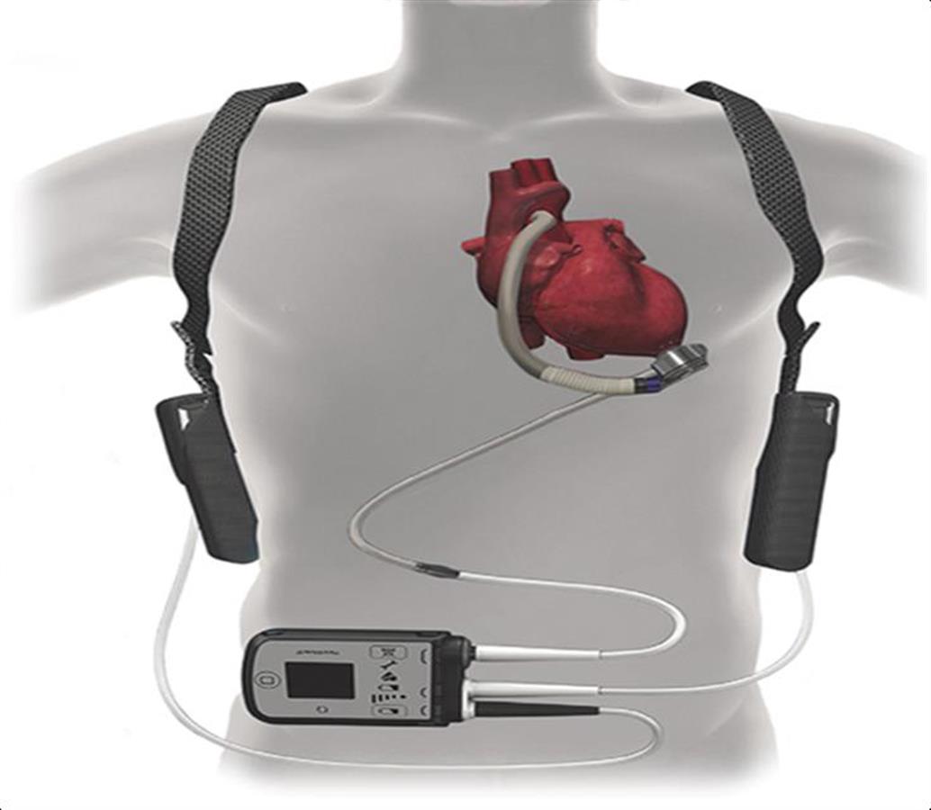 通过血泵升压后,再回输到动脉系统,替代心脏"工作",维持血液循环,是