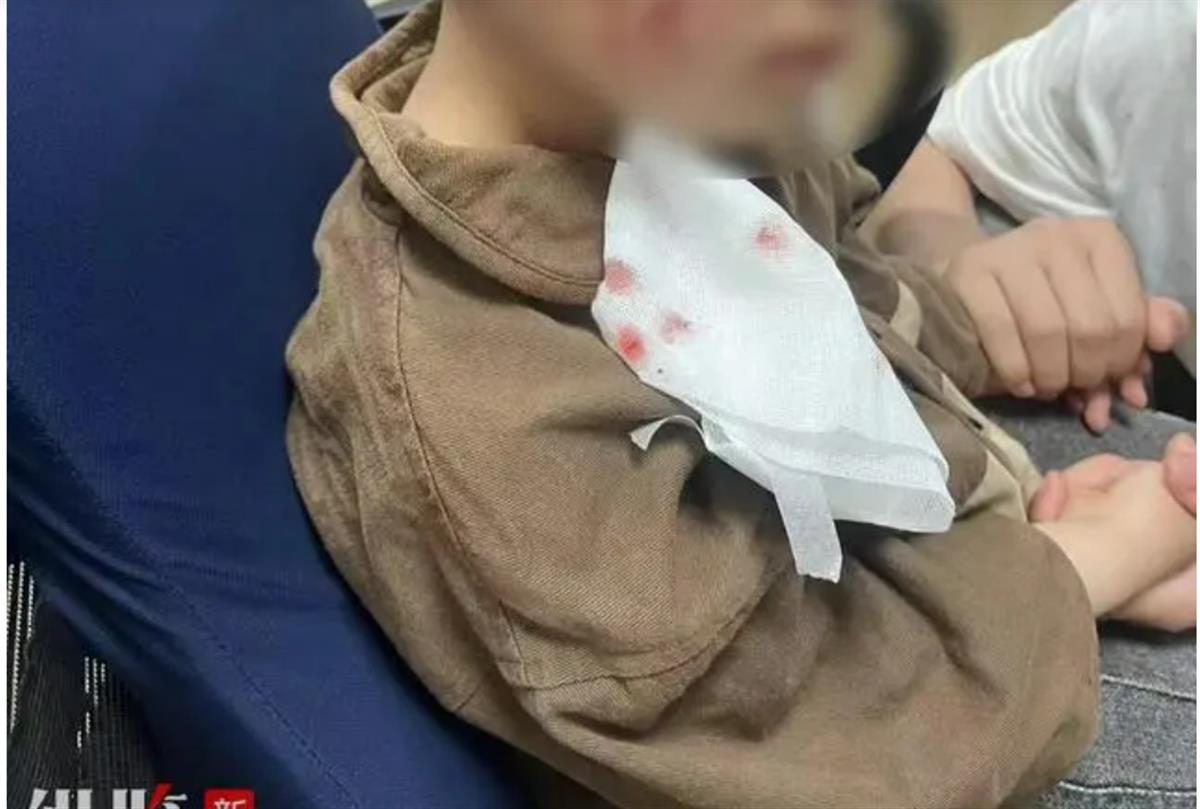 A3岁男童被犬咬伤18天后不幸离世.png A3岁男童被犬咬伤18天后不幸离世.png