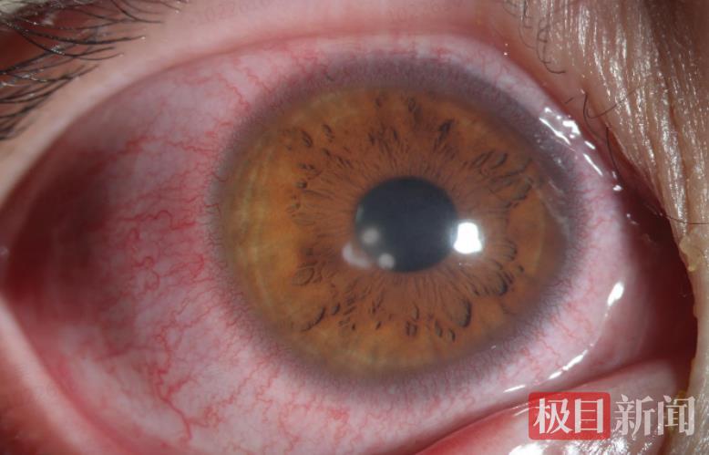 患者的眼球爬满红血丝.png