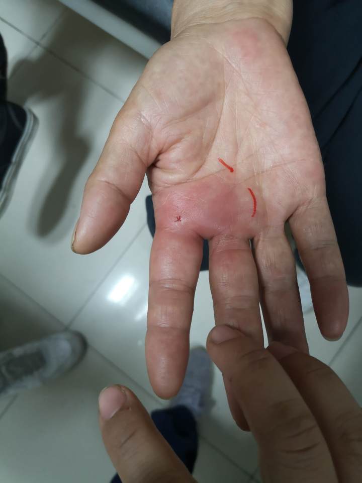 的胡晨姣医生发现刘阿姨的右手手掌靠近食指的位置,有一个红色伤口,像