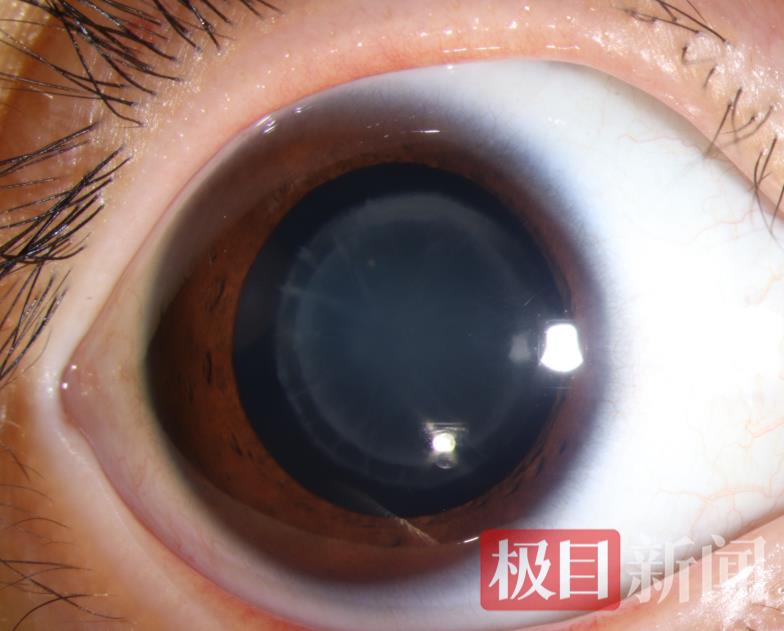 晶状体绕核型混浊.png
