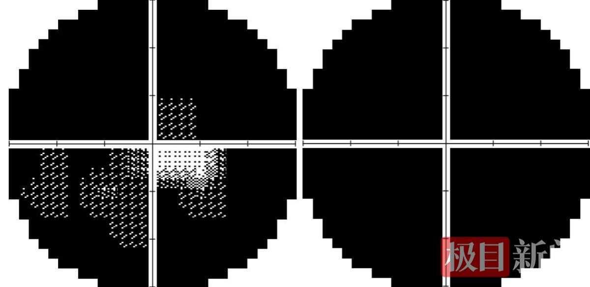 右眼及左眼视野检查.png