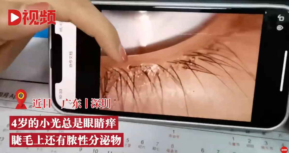 674岁娃娃眼睛痒,医生发现睫毛爬满阴虱 ,该虫以人体皮屑和吸血为生