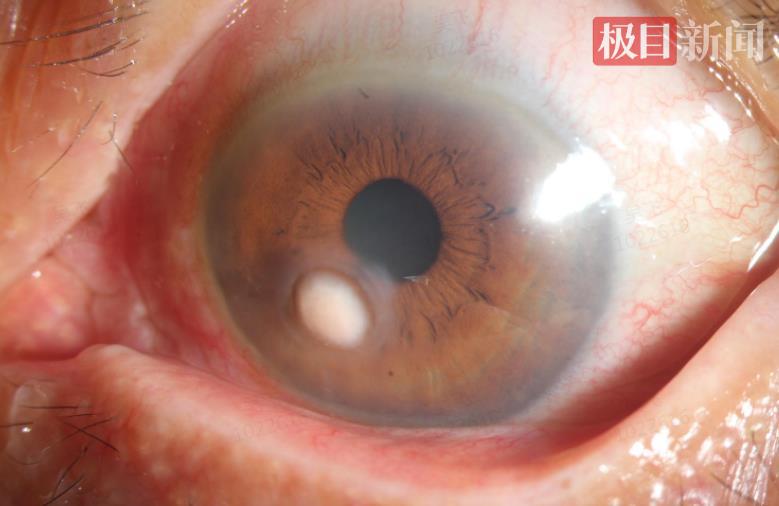患者眼睛上长出“蘑菇”，图为“蘑菇”光滑的一面.png