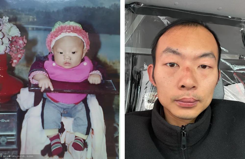 唇腭裂患者为嫣然发声，善意之光长照人间