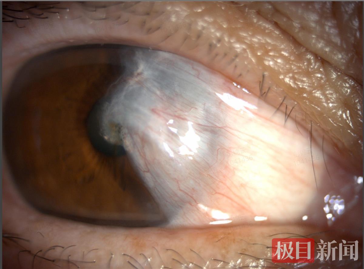 刘女士的结膜增生变性已遮盖瞳孔区一大半.jpg