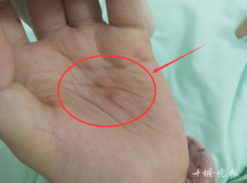 女孩莫名发烧4个月,湖北十堰多专家会诊找到致命"真凶"