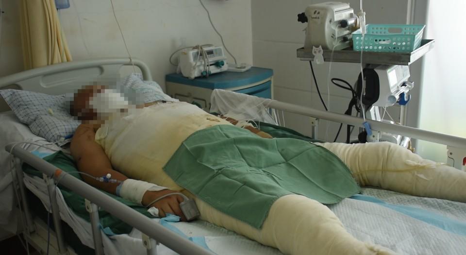 临沂一17岁少年重度烧伤,盼好心市民伸援手