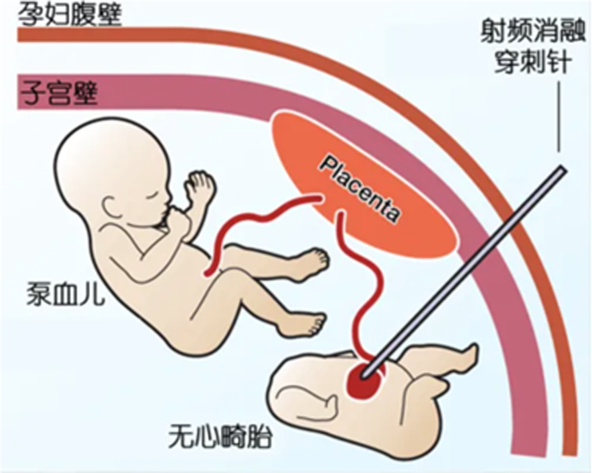 双胞胎一胎“无心”还在抽另一胎血，上海医护联手救治产妇和胎儿 | 极目新闻