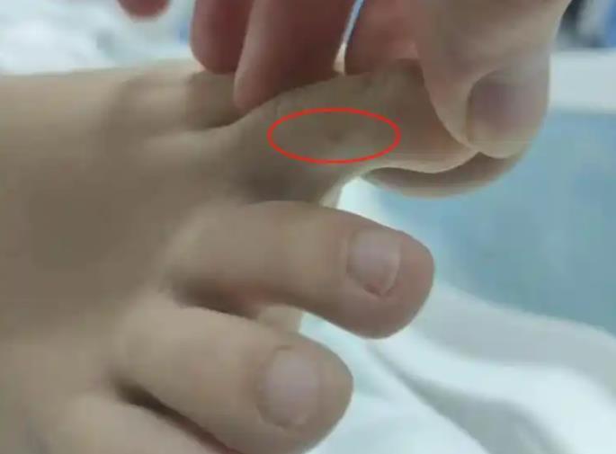 27岁女子被咬伤的伤口 来自红星新闻.png 27岁女子被咬伤的伤口 来自红星新闻.png