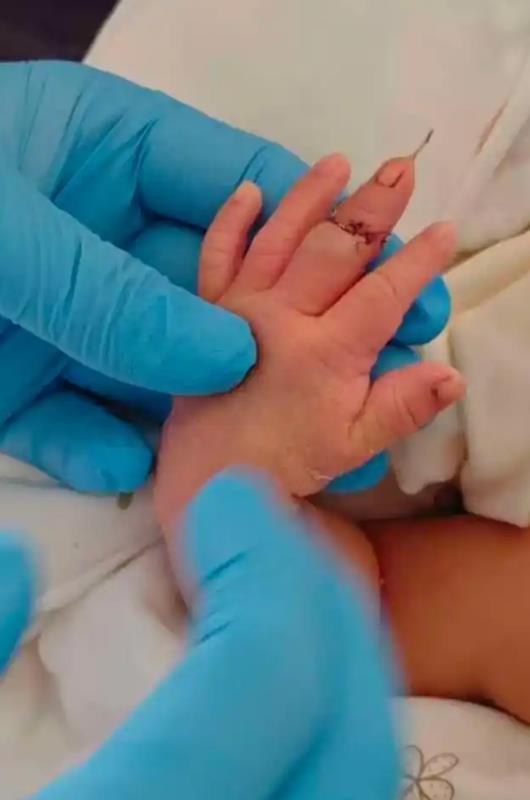 助产士失误剪断新生儿手指，低级失误背后的原因探究