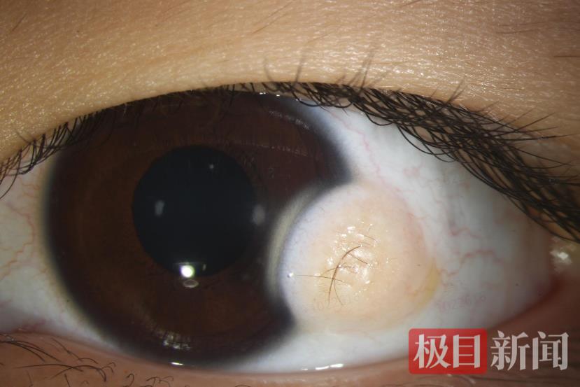患者左眼角膜上的角结膜皮样瘤.png