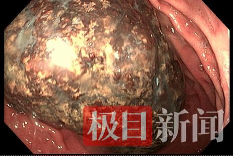 图为巨大胃石.png 图为巨大胃石.png