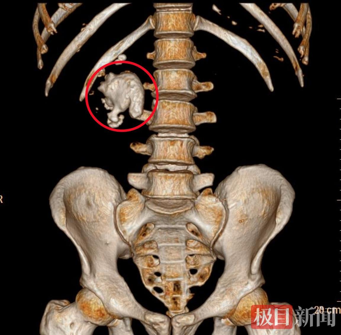 红圈处为CT三维重建影像显示的巨型铸型结石.jpg