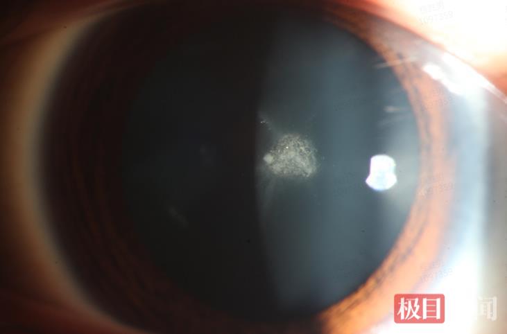患者眼睛晶状体后囊中央呈灰白色混浊.png