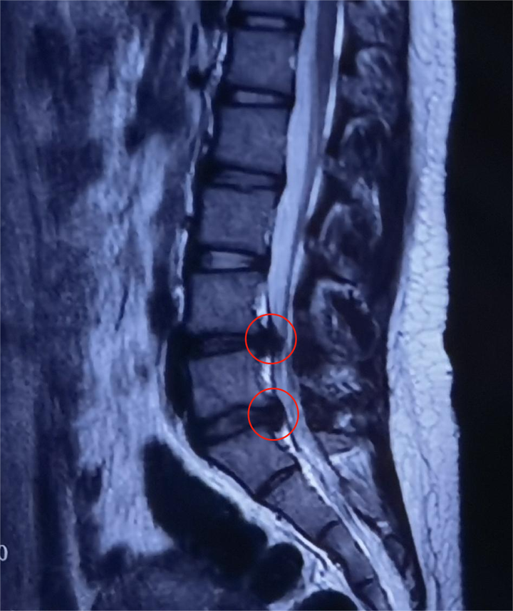 经过系统专科查体及影像学检查,发现茜茜的腰4/5,腰5/骶1椎间盘膨出