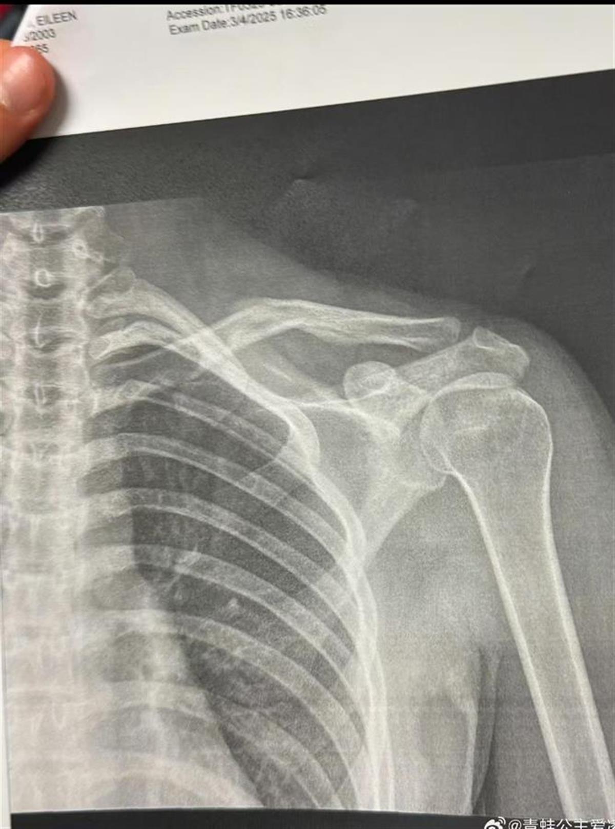 骨头伤.jpg