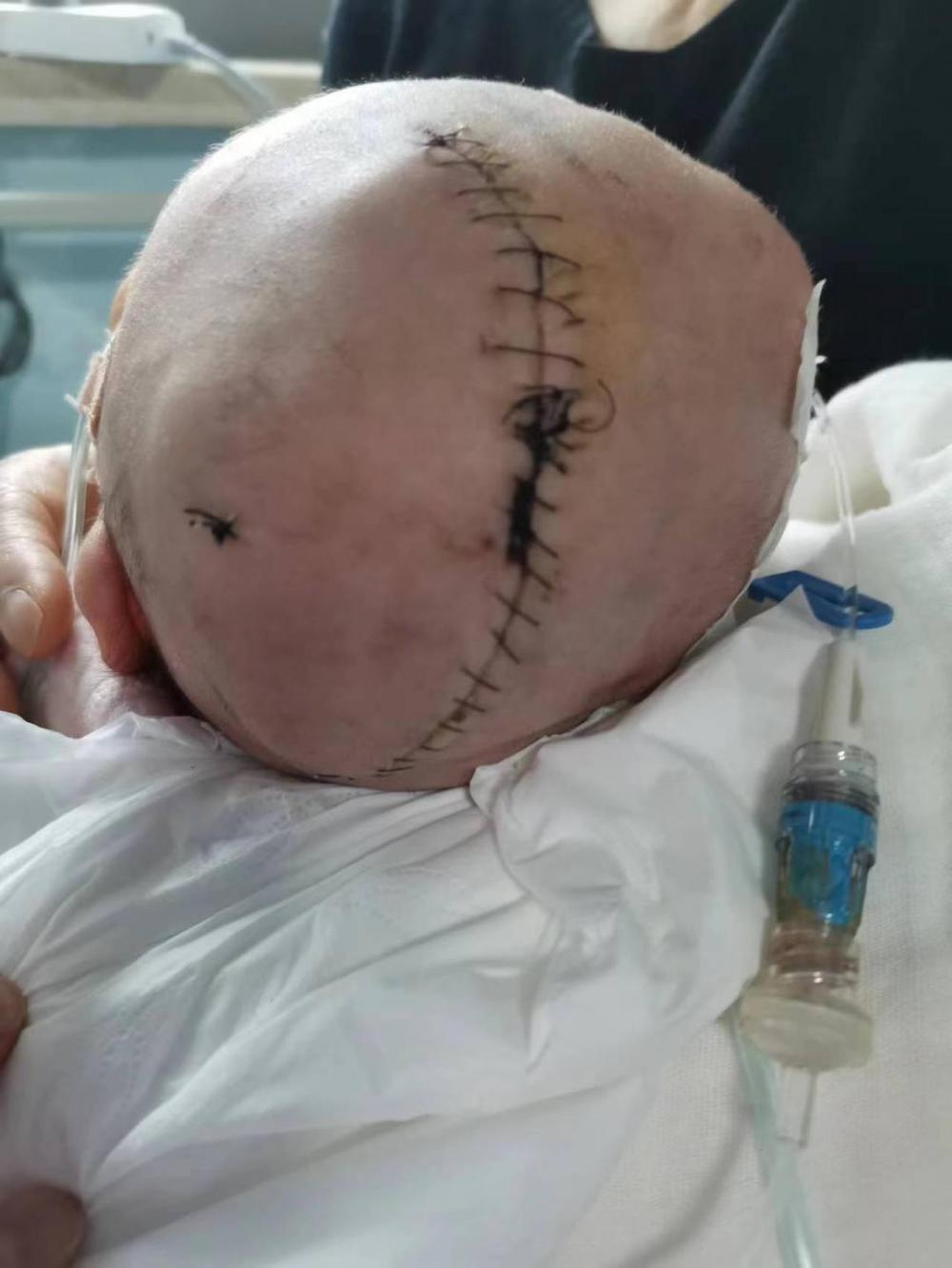 婴儿出生后被发现颅骨骨折家长质疑医生操作不当医院会承担责任但需