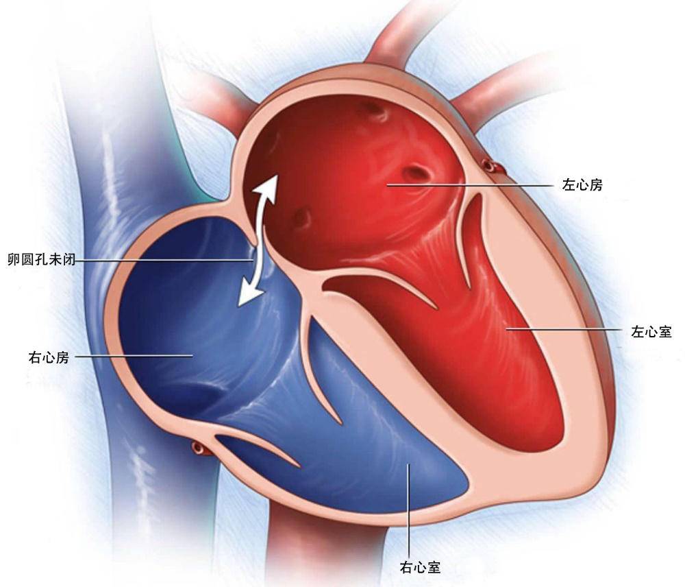 常州二院心内科主任纪元解释道:卵圆孔是胚胎时期心脏房间隔遗留的一